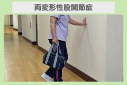 両変形性股関節症 60代女性のイメージ