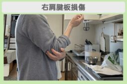 右肩腱板損傷 60代女性のイメージ