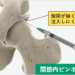関節内ピンポイント注射
