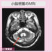 小脳梗塞のMRI　2023-07-07 15.50.25