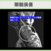頚椎症性脊髄症 幹細胞治療