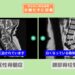 腰部脊柱管狭窄症、頚椎症性脊髄症