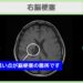 急性期脳梗塞 幹細胞治療