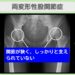 変形性股関節症(臼蓋形成不全) 幹細胞治療