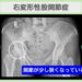 右変形性股関節症　幹細胞治療