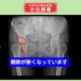 右変形性関節症　部な誘導　幹細胞治療