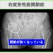 右変形性股関節症　幹細胞治療