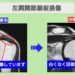 肩関節腱板損傷　ビフォーアフター