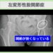 左変形性股関節症（臼蓋形成不全）