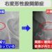 右変形性股関節症