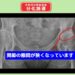 変形性股関節症