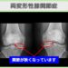 両変形性膝関節症
