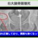 右大腿骨頭壊死症