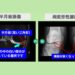 半月板損傷・変形性膝関節症