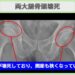 両大腿骨頭壊死症