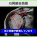 右肩腱板損傷
