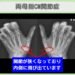 両母指CM関節症