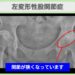 左変形性股関節症