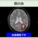脳出血MRI