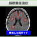 脳梗塞後遺症