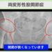 両変形性股関節症