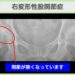 右変形性股関節症