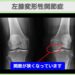 右膝変形性関節症