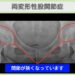 両変形性股関節症