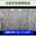 右変形性股関節症