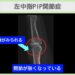 左中指PIP関節症のレントゲン所見（関節裂隙の狭小化と骨棘形成）