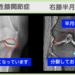 右変形性膝関節症 右膝半月板変性