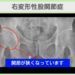 右変形性股関節症