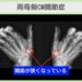 両母指CM関節症のレントゲン所見