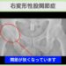 右変形性股関節症のレントゲン所見